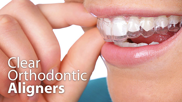 clear-orthodontic-aligners