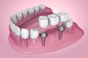 Dental Implants Procedure