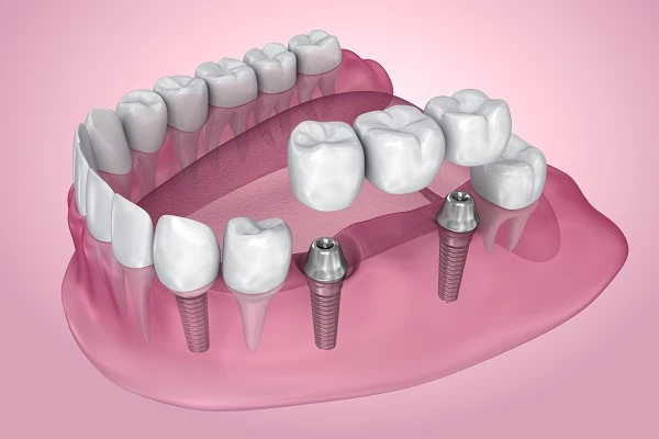 Procedimiento de implantes dentales