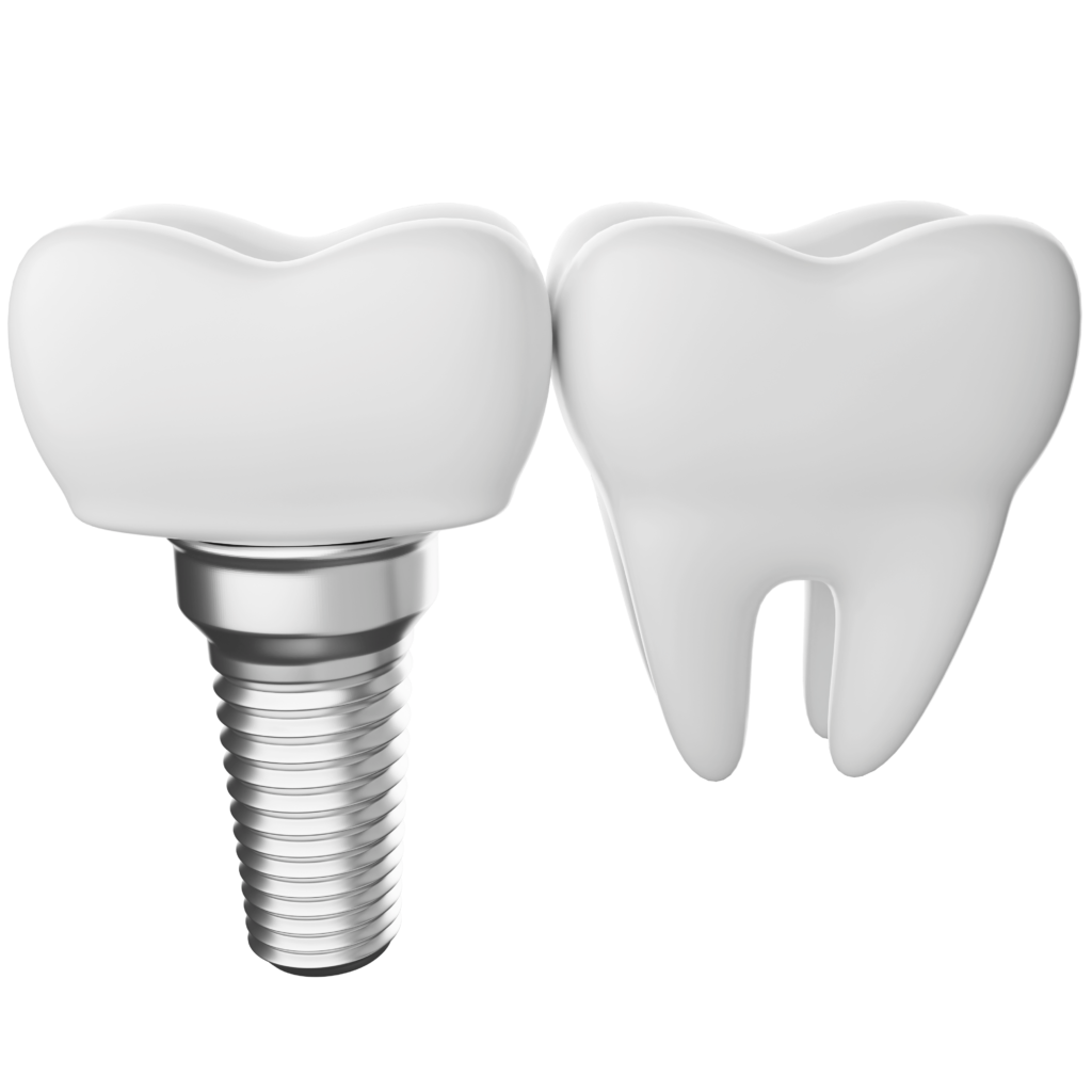 dental implant