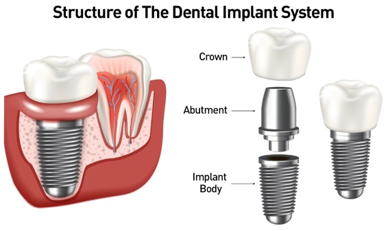 Sistema de implantes dentales