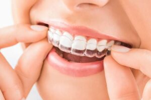 Benefits-of-Choosing-Invisalign-Over-Traditional-Braces