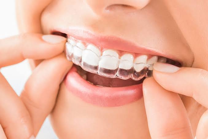 روایتی منحنی خطوط وحدانی پر Invisalign کو منتخب کرنے کے فوائد