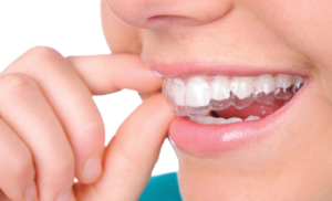 نوعمروں کے لیے Invisalign