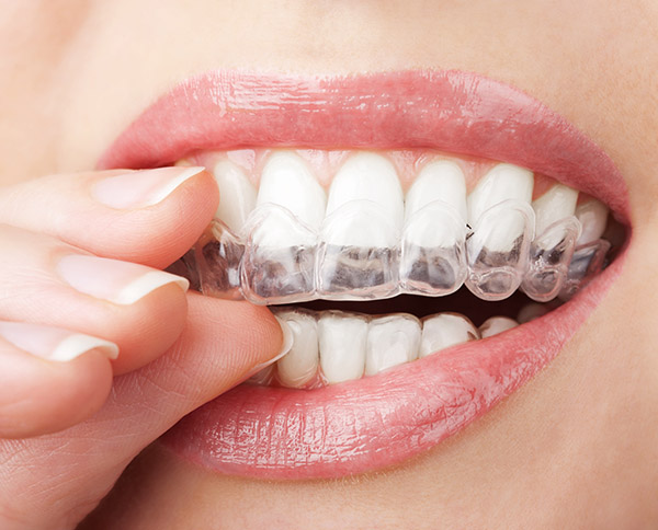 Enderezar los dientes con Invisalign