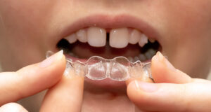 Invisalign gap for teeth