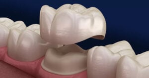 dental crown fell out