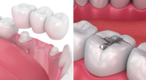 Blog filling or crown for cavity