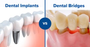 bridge vs implant