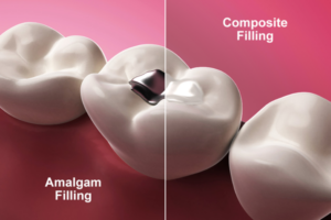 Blog dental filling cost Hayward