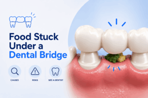 Blog Food Stuck Under a Dental Bridge