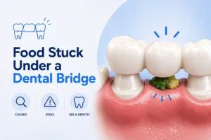 Pagkaing Natigil sa Ilalim ng Dental Bridge